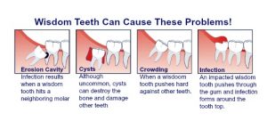 extraction teeth dental wisdom tooth them molar second done dentist healing nz