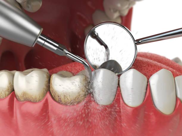 Dental cleaning procedure