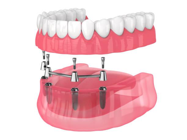 implant-restoration