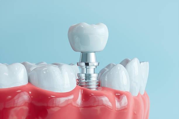 implant-restoration