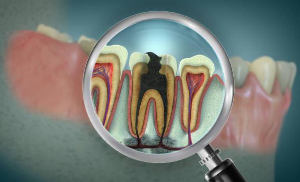 Root canal treatment procedure