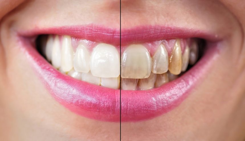 Scaling And Polishing Hill Park Dental Scaling and polishing hill park dental